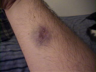ugly bruise